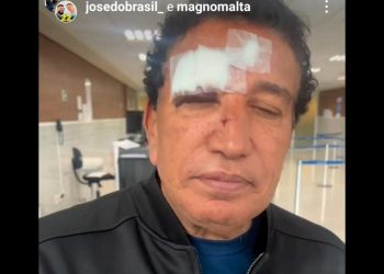 Magno Malta aparece com olho roxo e nariz quebrado: “Escorregou no banheiro”