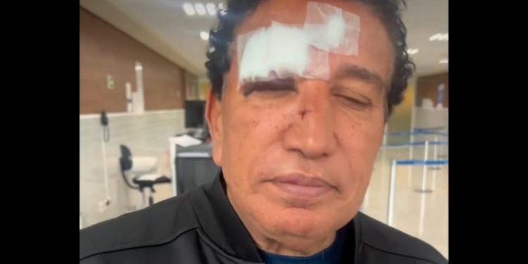 Magno Malta aparece com olho roxo e nariz quebrado: “Escorregou no banheiro”